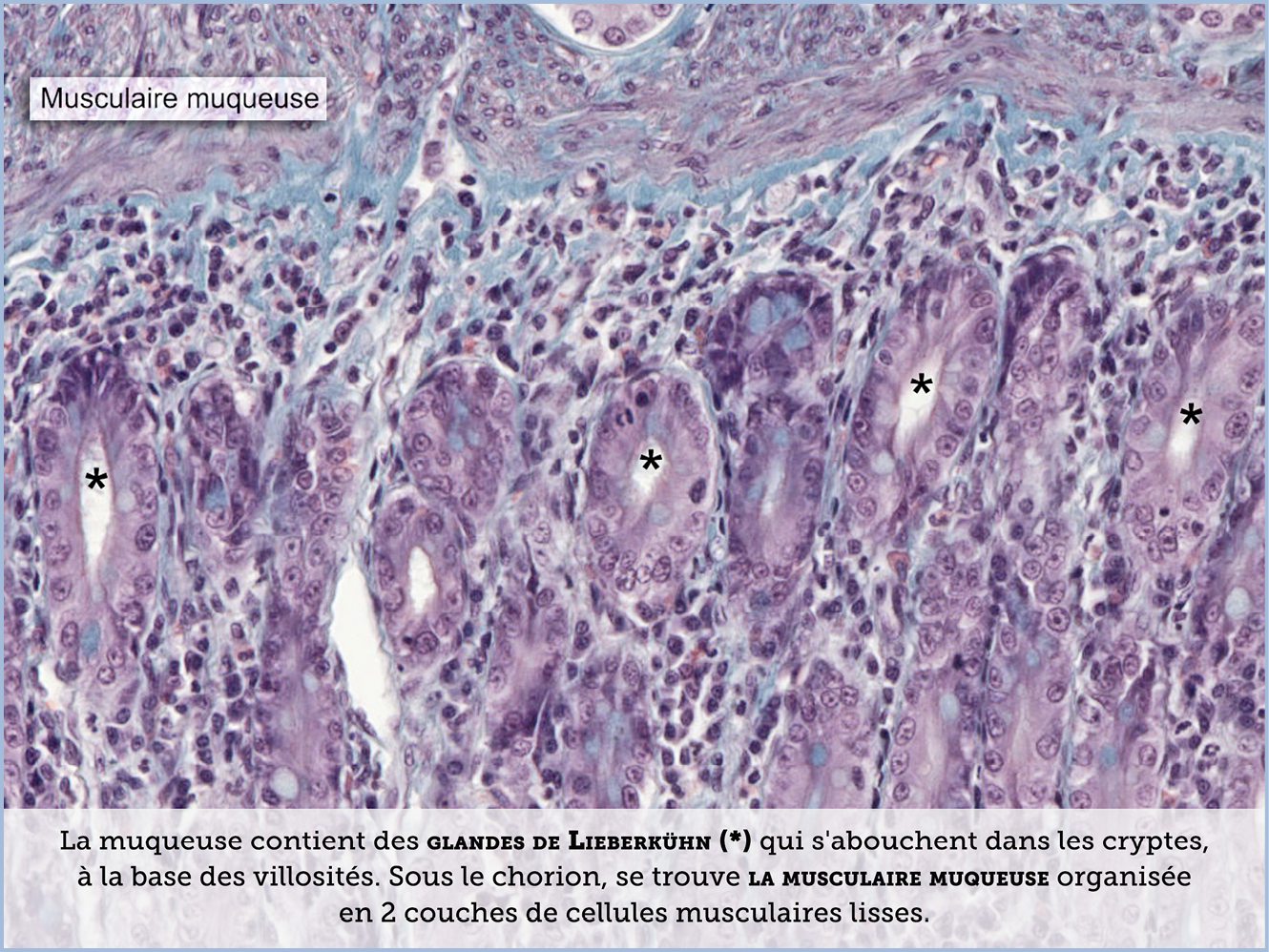 FICHE 2 TUMEUR WARTHIN ECRAN C