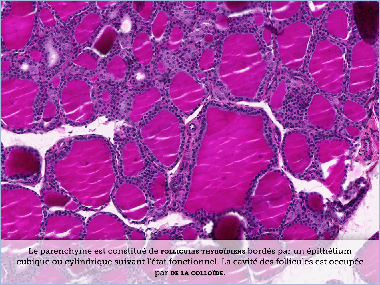 FICHE 2 TUMEUR WARTHIN ECRAN C