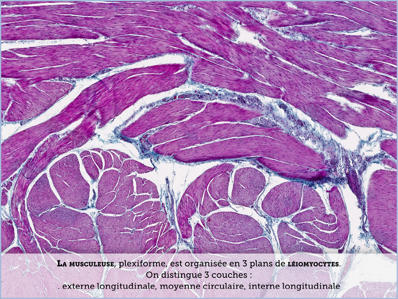 FICHE 2 TUMEUR WARTHIN ECRAN B