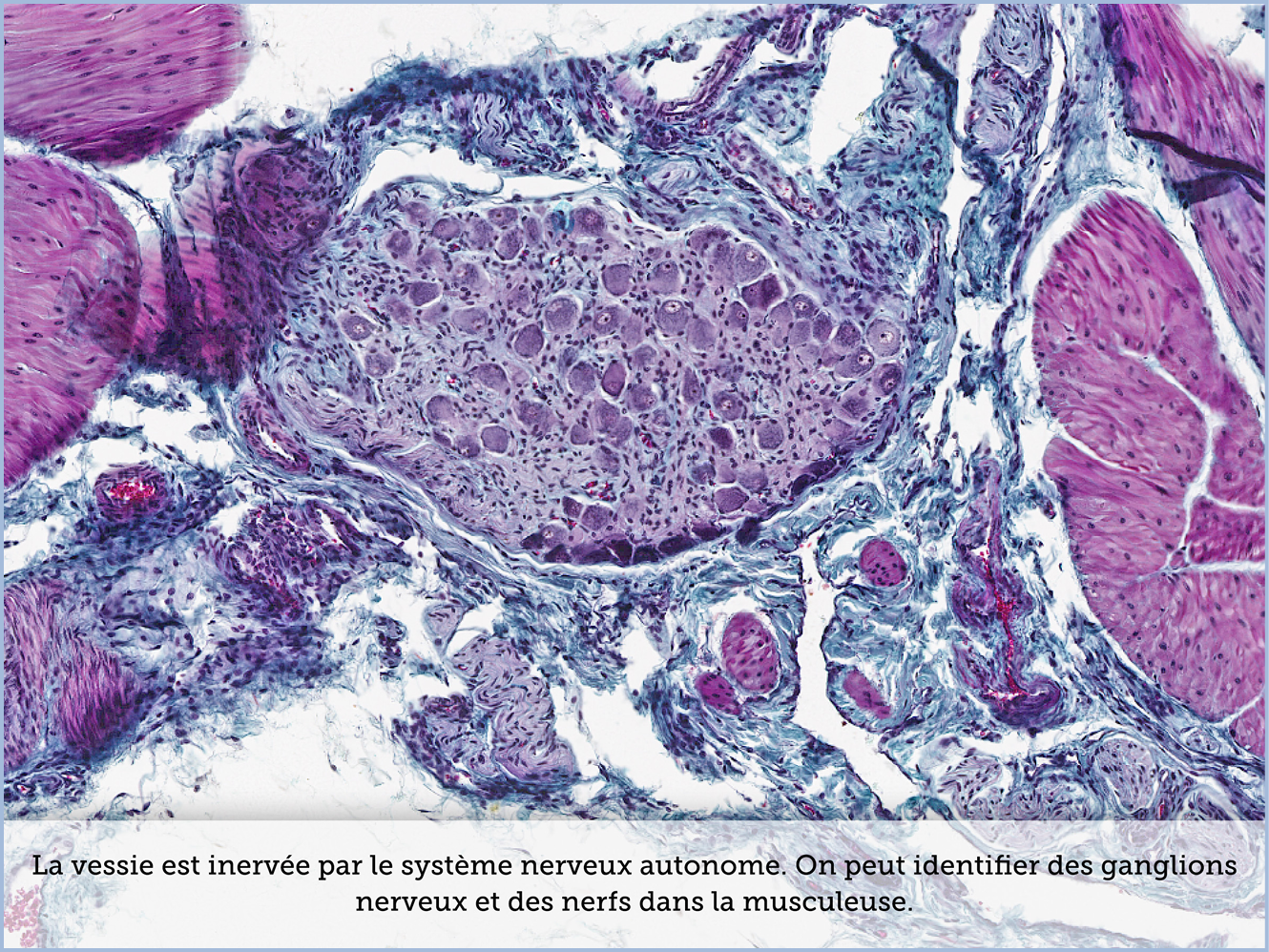 FICHE 2 TUMEUR WARTHIN ECRAN A