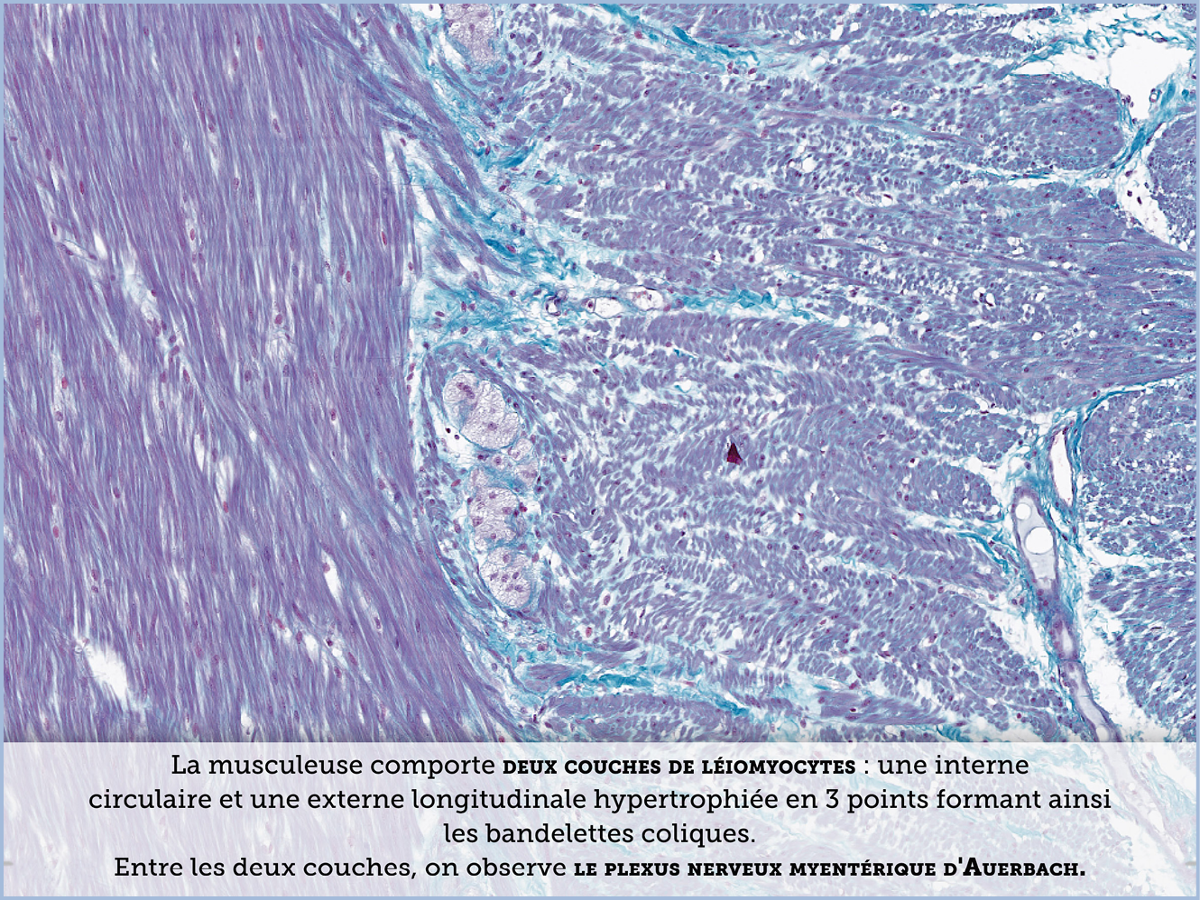 FICHE 2 TUMEUR WARTHIN ECRAN A