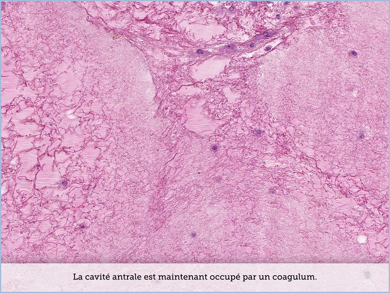 FICHE 2 TUMEUR WARTHIN ECRAN C