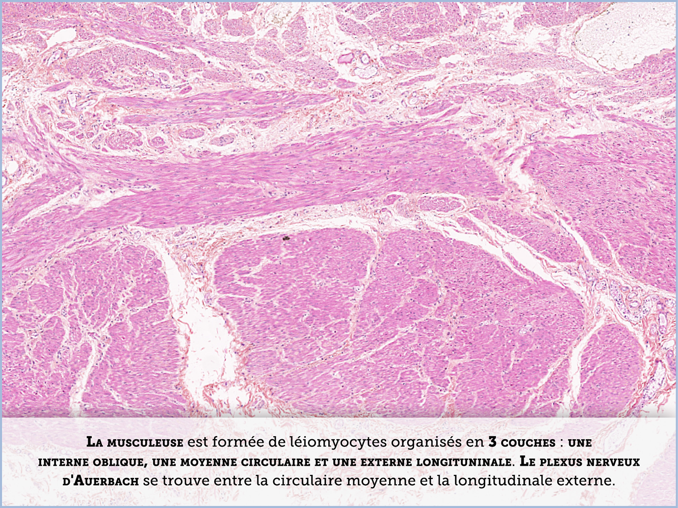 FICHE 2 TUMEUR WARTHIN ECRAN A
