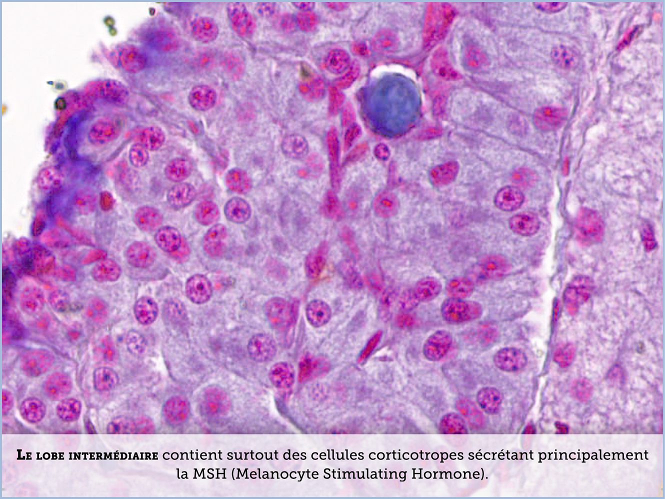 FICHE 2 TUMEUR WARTHIN ECRAN B