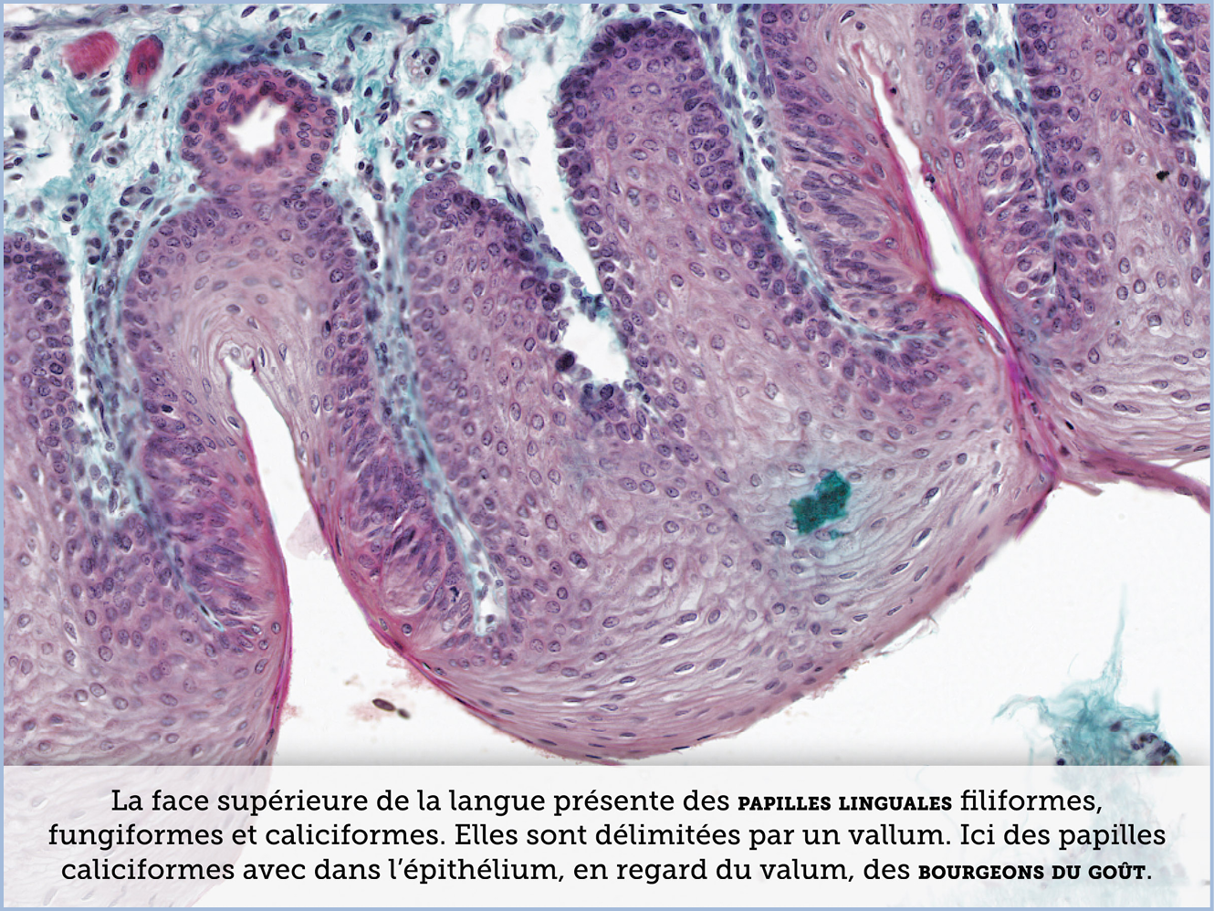 FICHE 2 TUMEUR WARTHIN ECRAN C