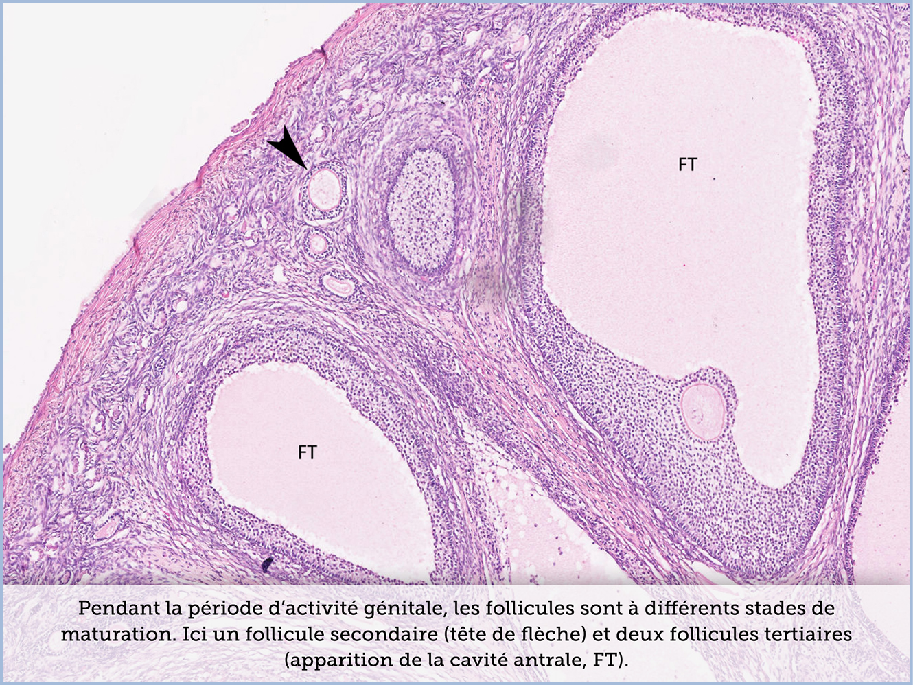 FICHE 2 TUMEUR WARTHIN ECRAN C