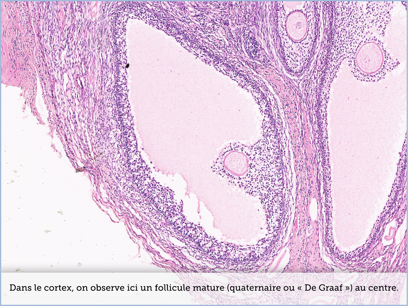 FICHE 2 TUMEUR WARTHIN ECRAN B