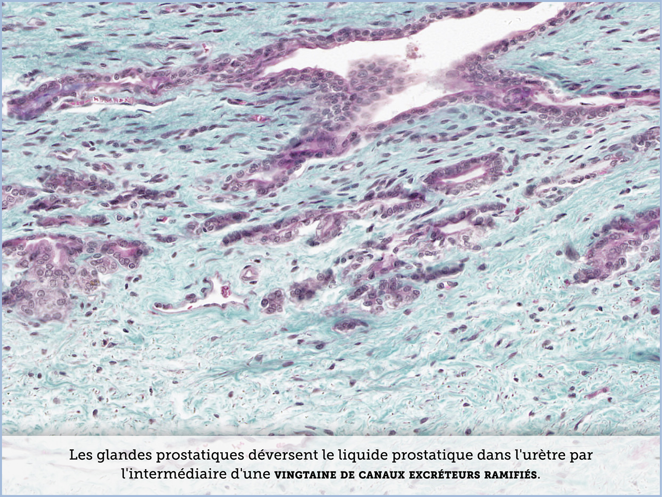 FICHE 2 TUMEUR WARTHIN ECRAN C