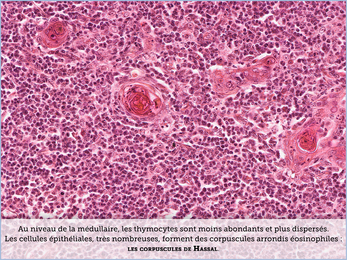 FICHE 2 TUMEUR WARTHIN ECRAN A