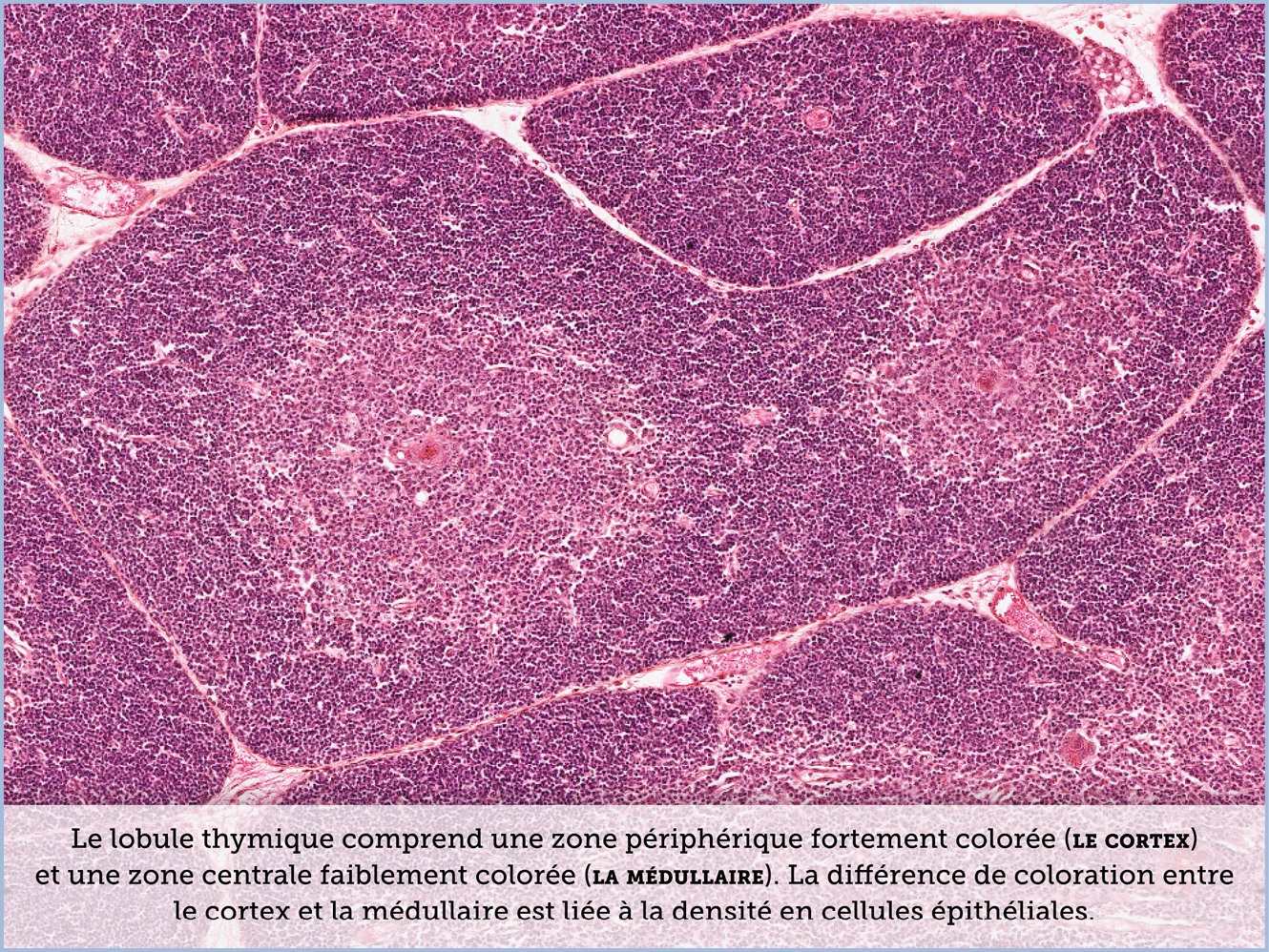 FICHE 2 TUMEUR WARTHIN ECRAN C
