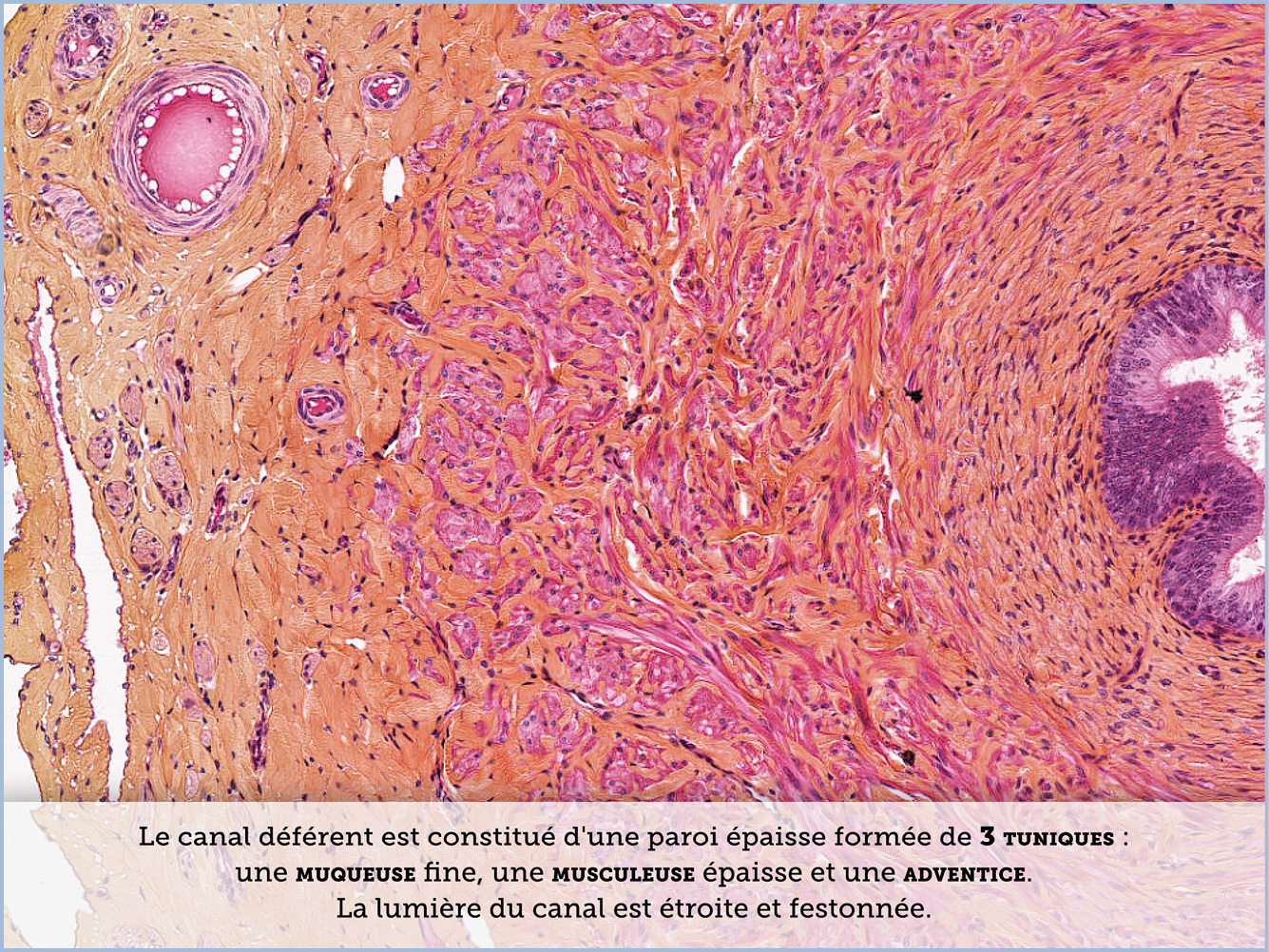 FICHE 2 TUMEUR WARTHIN VIDEO