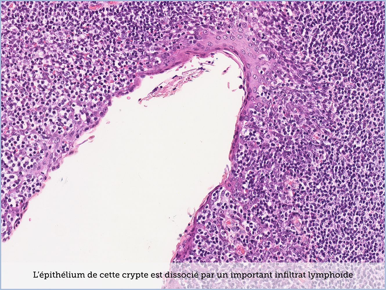 FICHE 2 TUMEUR WARTHIN ECRAN C