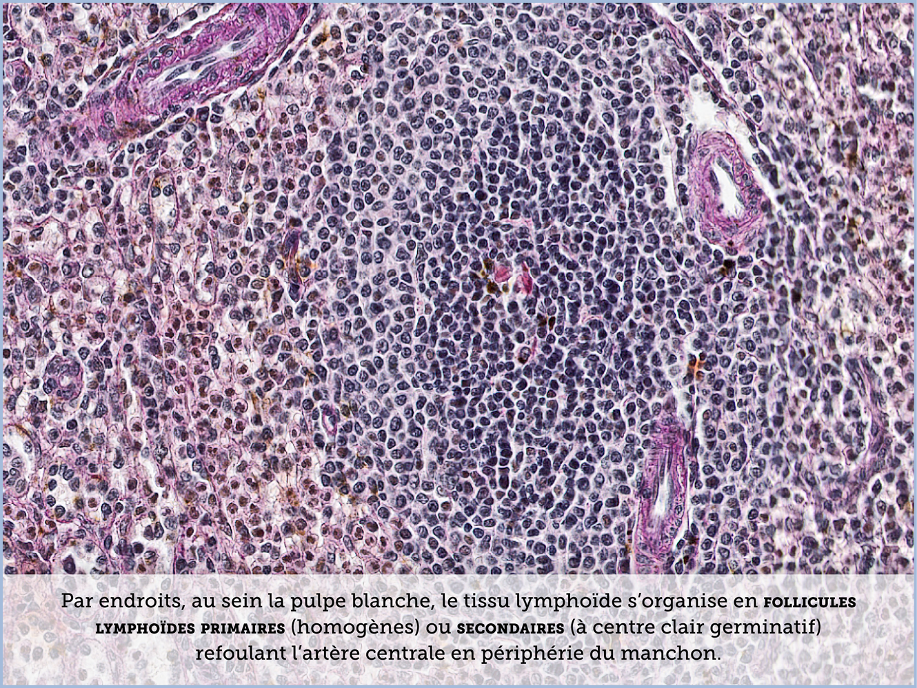 FICHE 2 TUMEUR WARTHIN ECRAN B