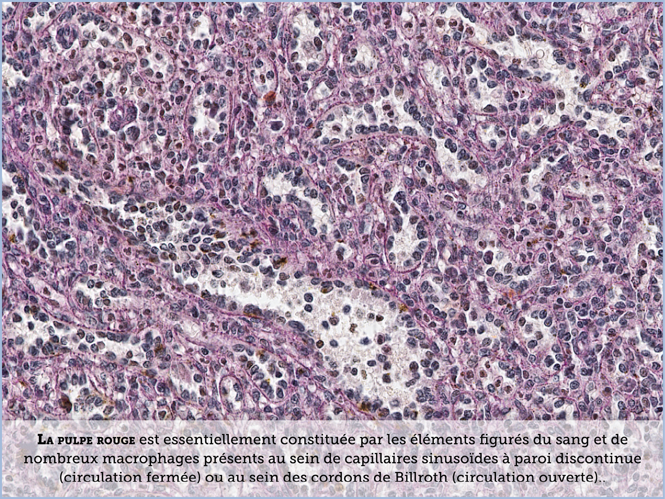 FICHE 2 TUMEUR WARTHIN ECRAN A
