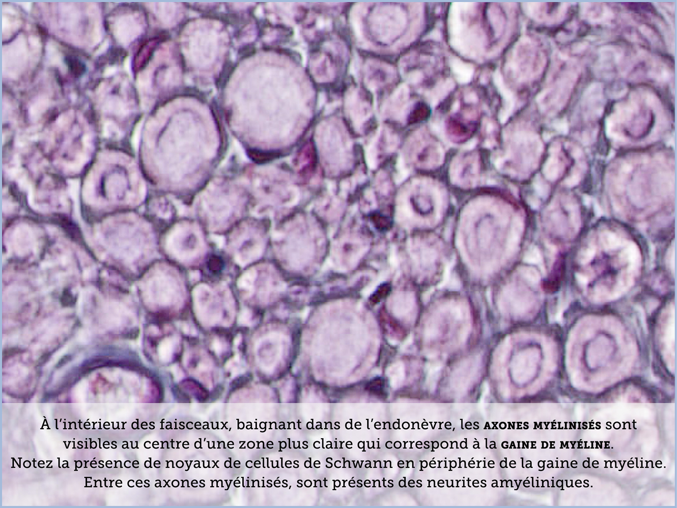 FICHE 2 TUMEUR WARTHIN ECRAN C