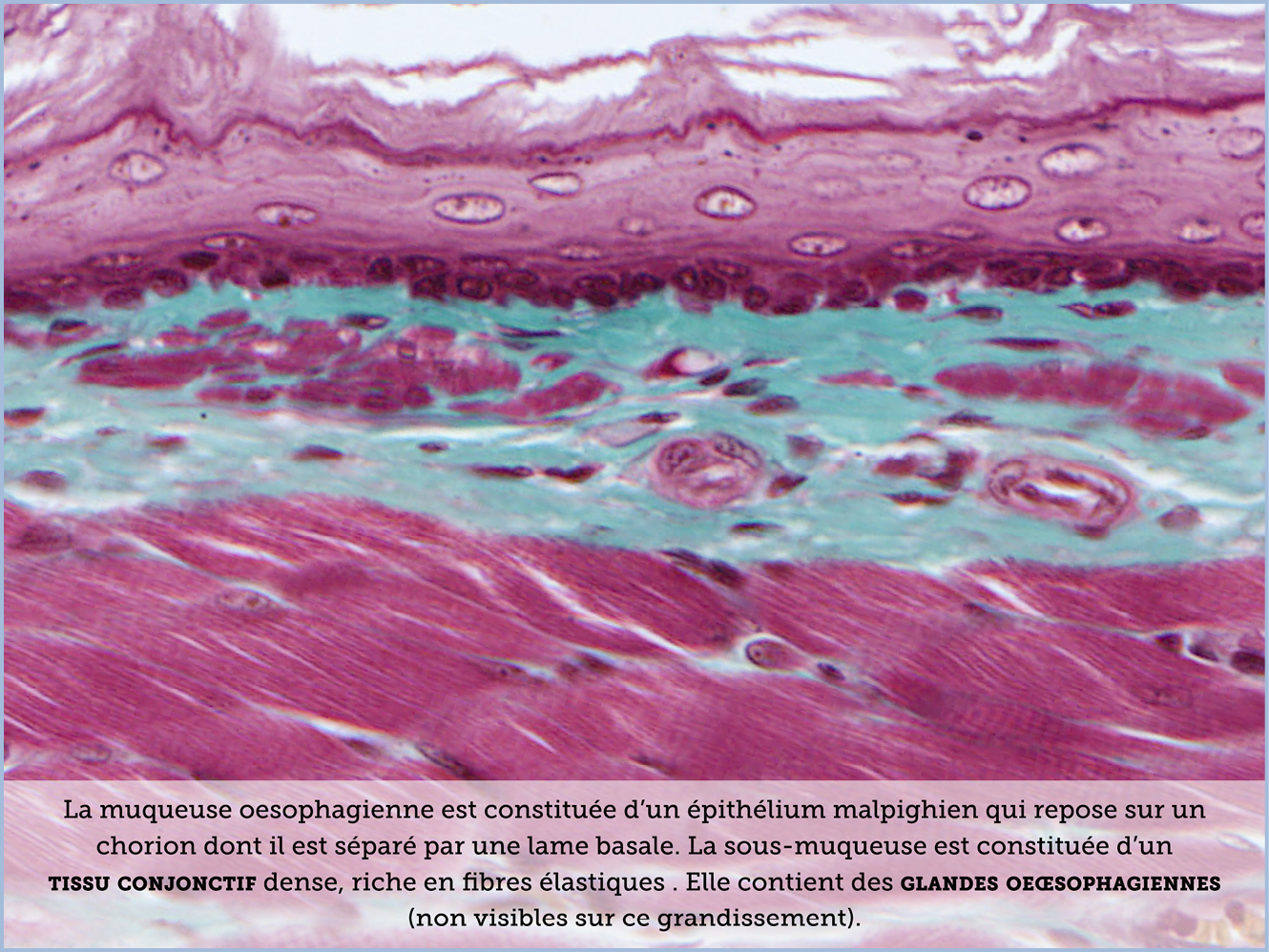 FICHE 2 TUMEUR WARTHIN ECRAN B