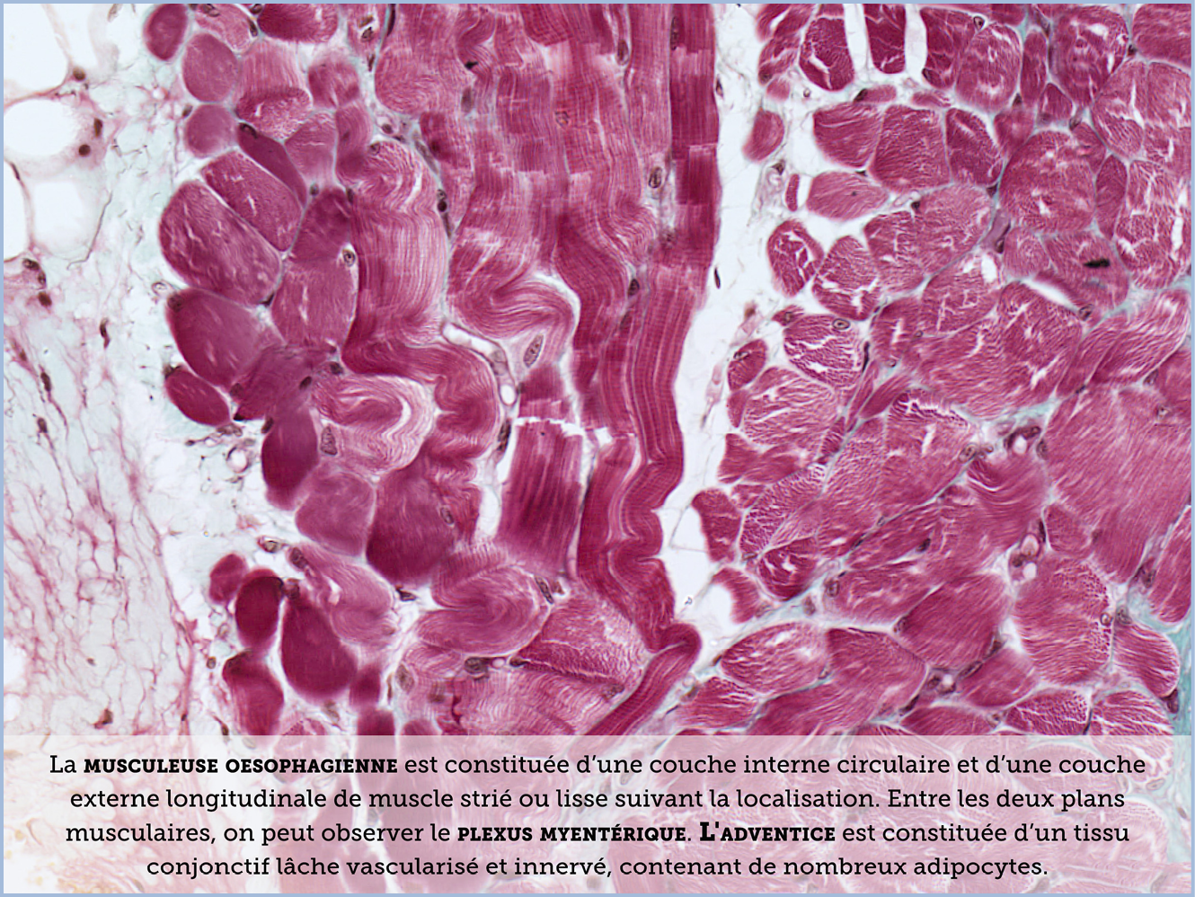 FICHE 2 TUMEUR WARTHIN ECRAN A