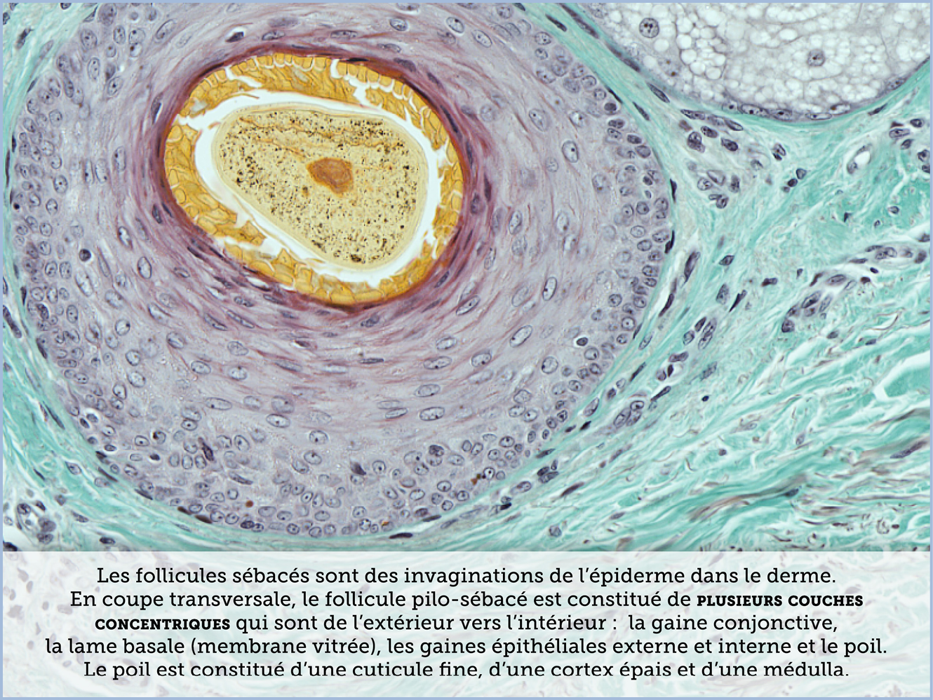 FICHE 2 TUMEUR WARTHIN ECRAN C
