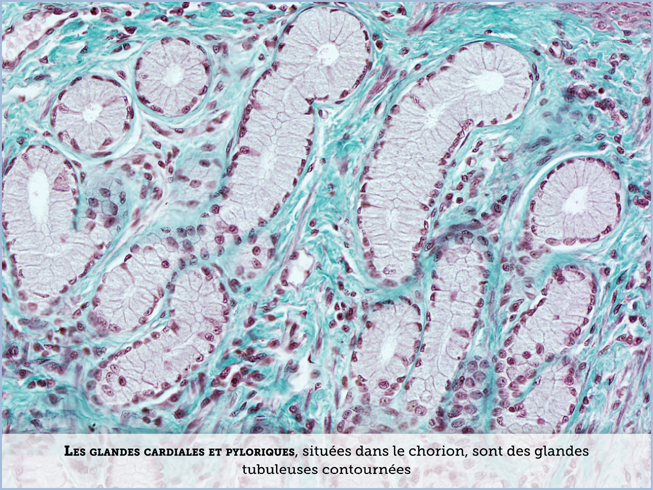 FICHE 2 TUMEUR WARTHIN ECRAN C
